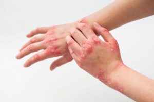 Dermatitis