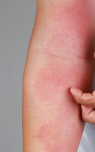 Dermatitis